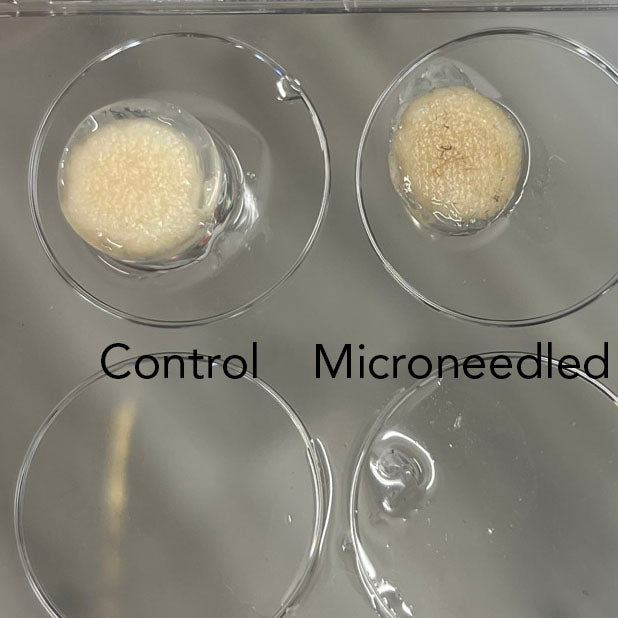 Microneedling decayed, thinned and discolored the surface of skin in human skin specimens